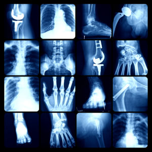 poly-accidenté